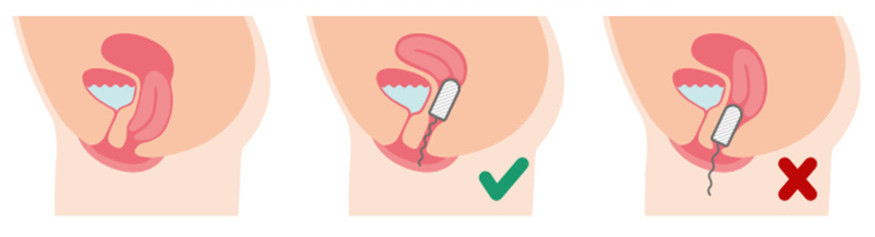 tampon contam