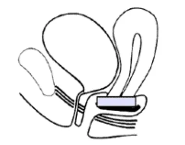 disc pessary