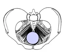 ring pessary